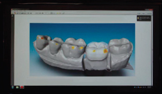 Zirconia