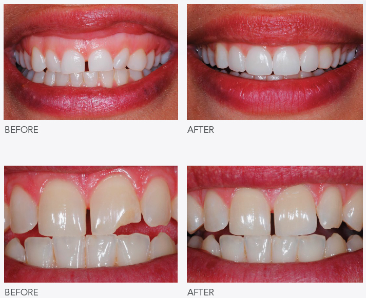 Before and after